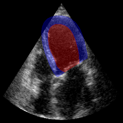 ../../_images/notebooks_metrics_myocardial_quality_example_10_0.png